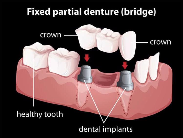 implant supported bridge