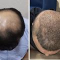 The search for Hair Transplant Clinic in Thane ends at DNA Royal