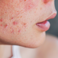 Clear, Glowing Skin with Acne Treatment in Thane