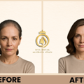 Best Hair Regrowth for Women in Thane at DNA Royal Aesthetic Clinic